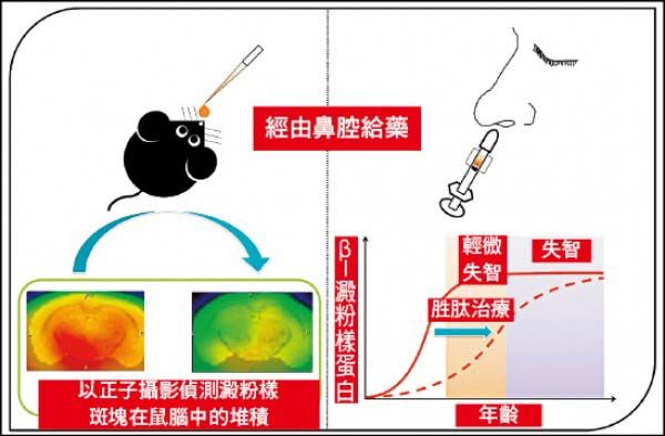 阿茲海默