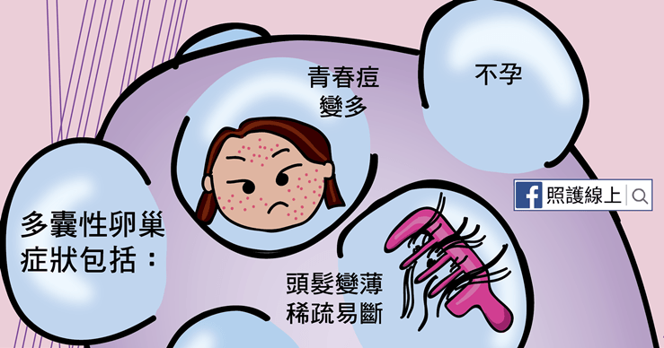 多囊性卵巢