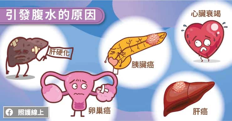 腹水