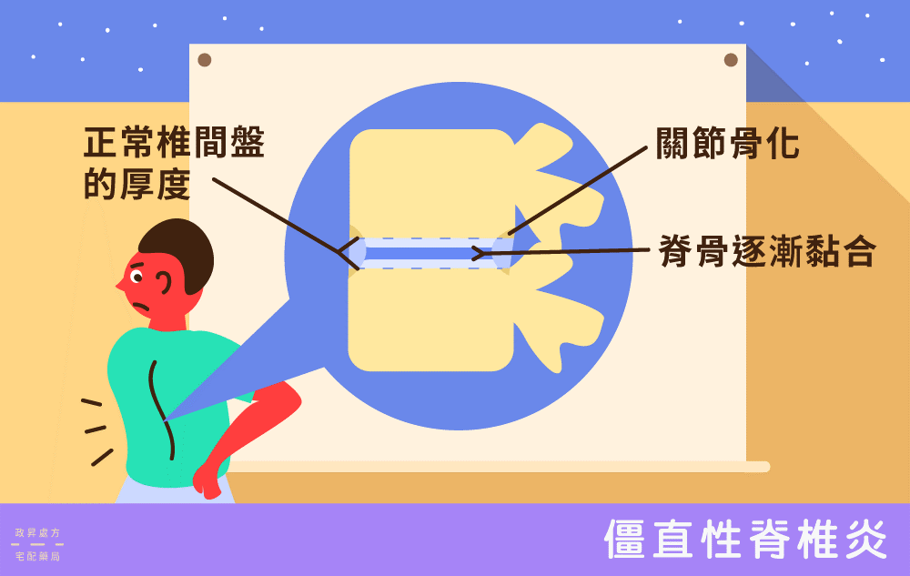 僵直性脊椎炎