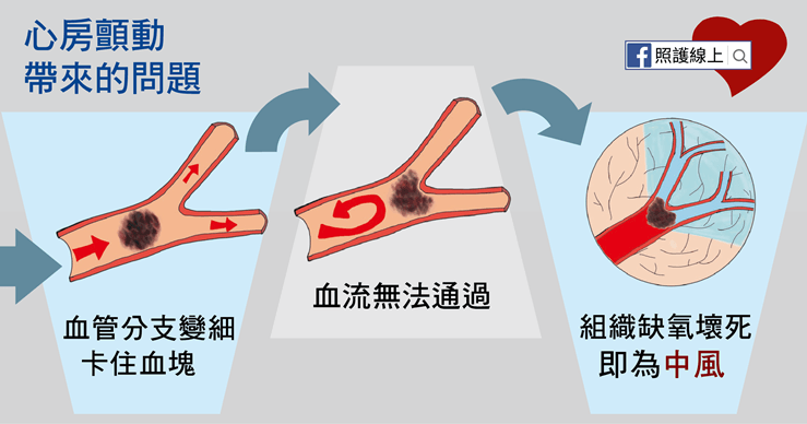 心房顫動
