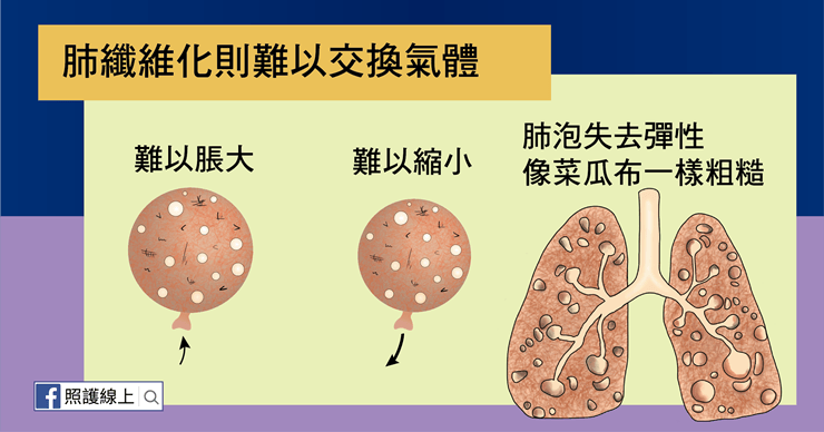 肺纖維化