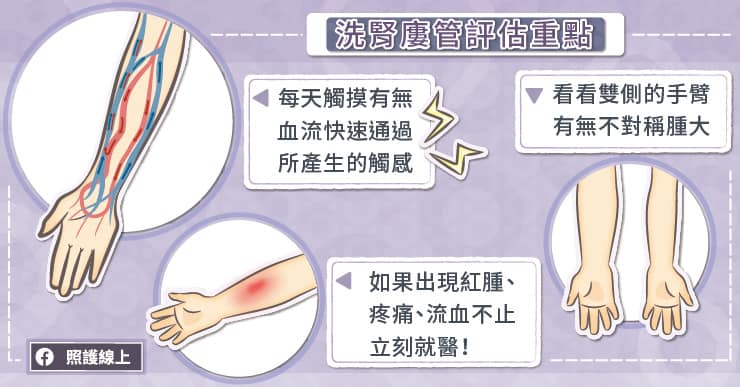 洗腎廔管
